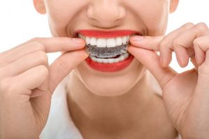 invisalign photo