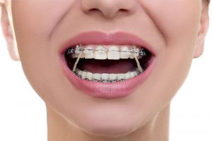 types of braces